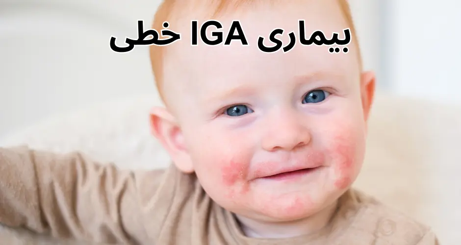 بیماری IGA خطی