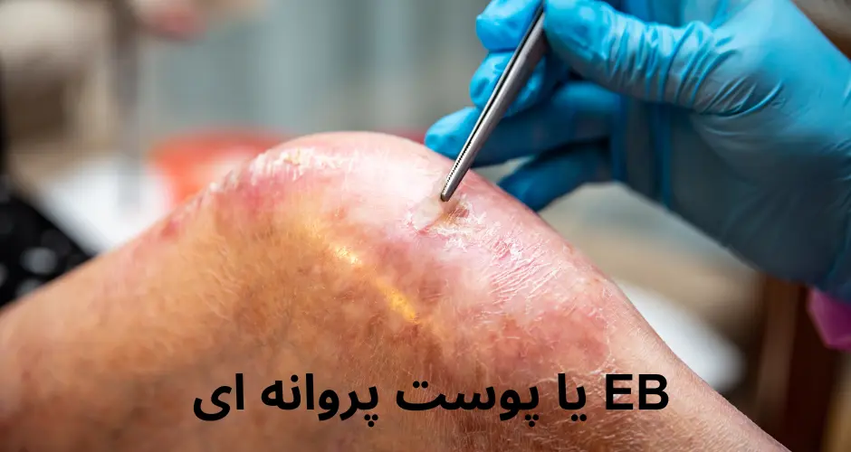 EB یا پوست پروانه ای