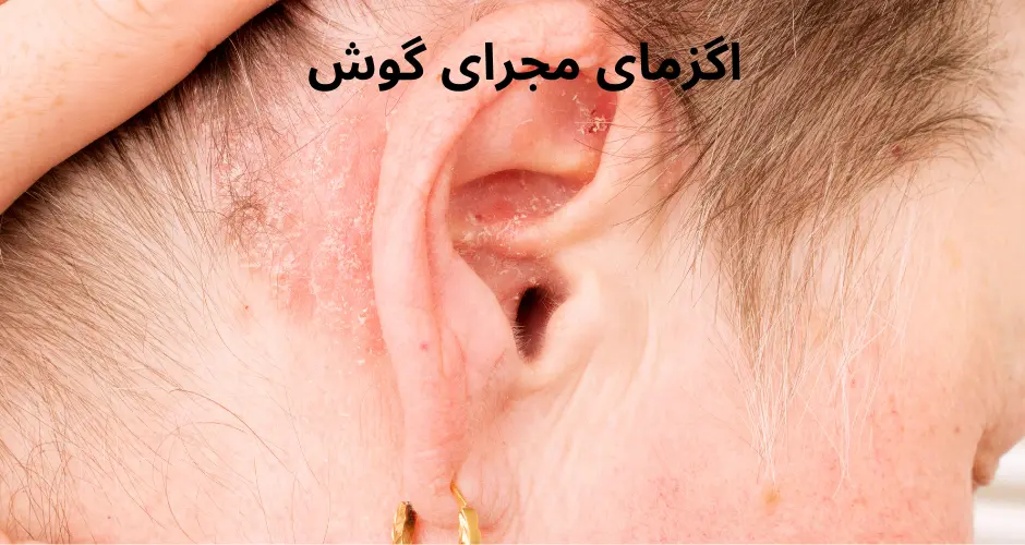 اگزمای مجرای گوش