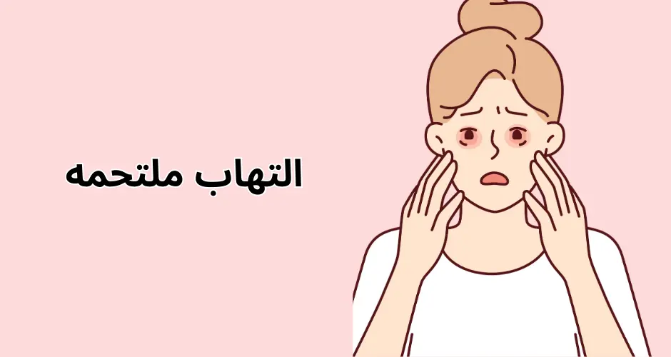 التهاب ملتحمه