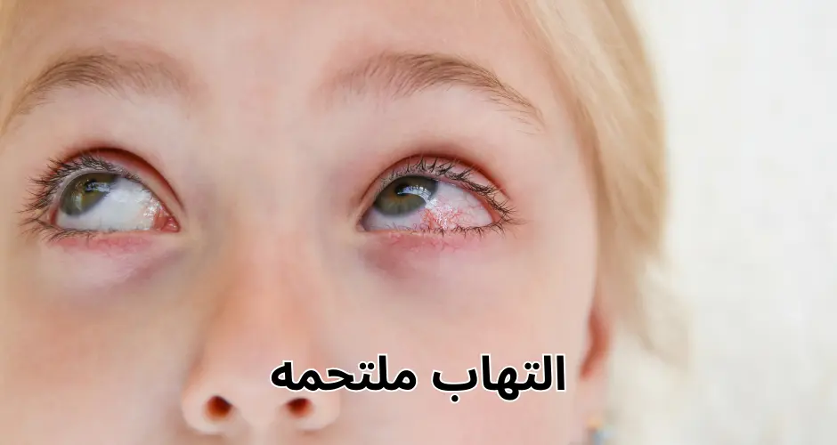 التهاب ملتحمه