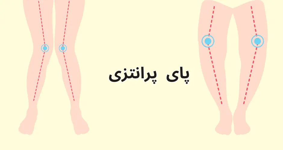 پای پرانتزی