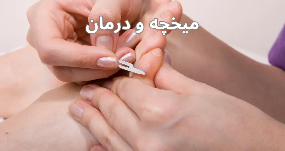 میخچه و درمان آن